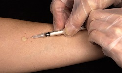 Mantoux test
